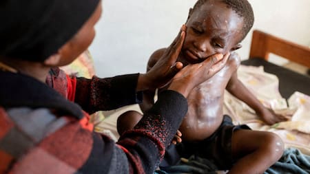 Mpox virus; viruela del mono. Foto: Reuters.