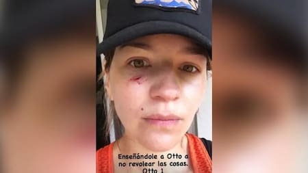 Marcela Kloosterboer sufrió una herida cortante en el rostro por un accidente casero