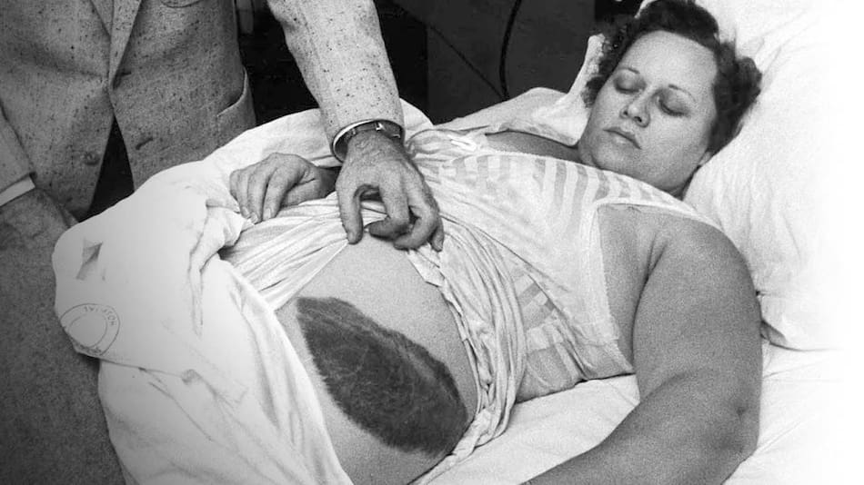 Ann Hodges, la mujer que sobrevivió tras ser golpeada por un meteorito