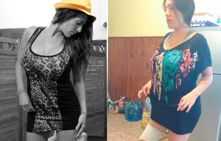 Mariela Ayala - Liposucción - Pierna amputada
