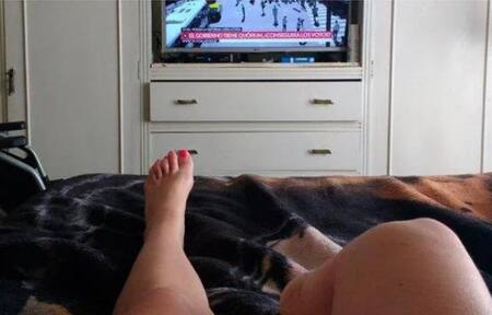 Mariela Ayala - Liposucción - Pierna amputada