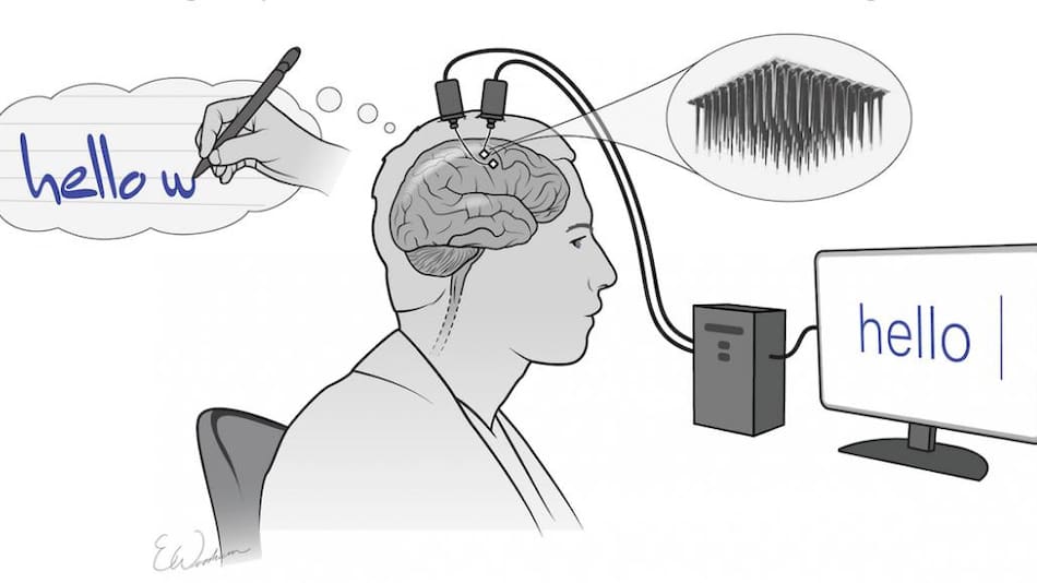 Implante cerebral