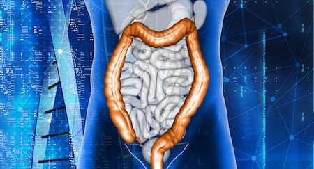 Cáncer de Cólon. Freepik