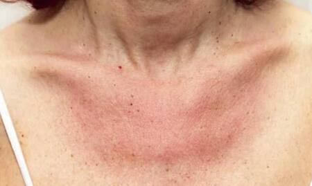 Coronavirus, piel, salud