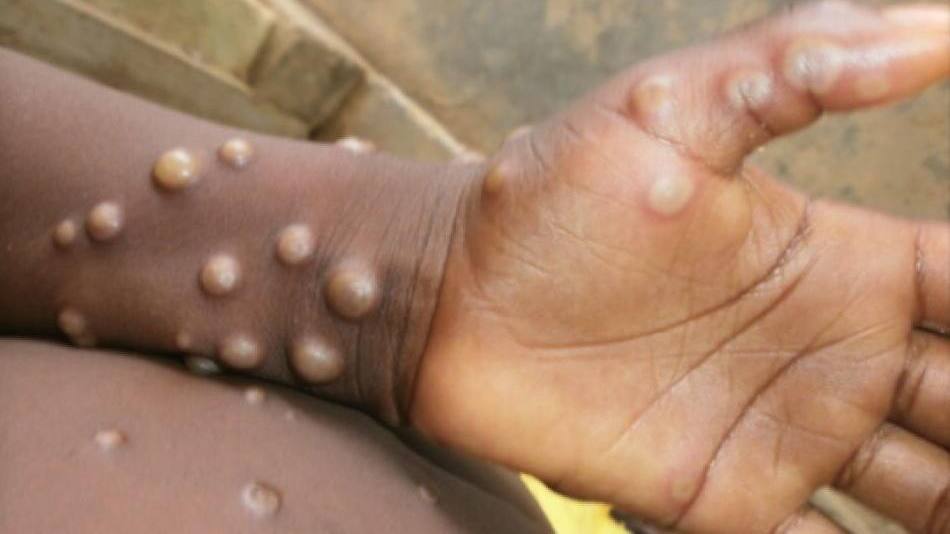 Viruela del mono, enfermedad. Foto: Reuters.