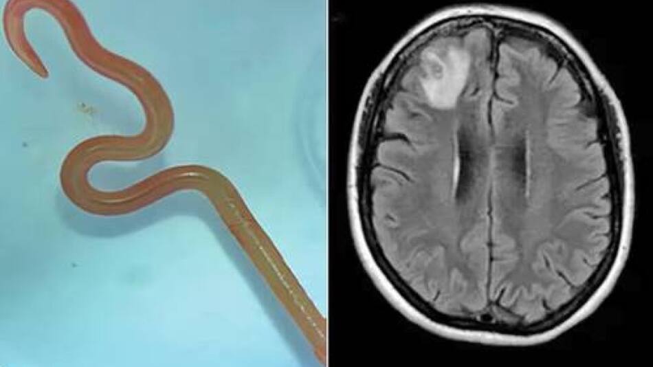 Médicos australianos de Canberra extrajeron por primera vez el gusano redondo vivo. Foto: @TNChiapas