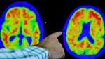 Lucha contra el alzheimer: un hallazgo belga podría ayudar al desarrollo de nuevos fármacos