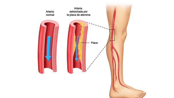 La enfermedad arterial periférica cuadruplica el riesgo de infarto