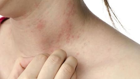 Dermatitis atópica