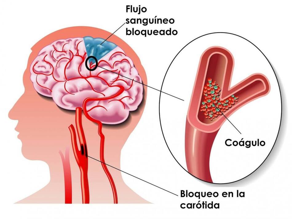 Salud - ACV
