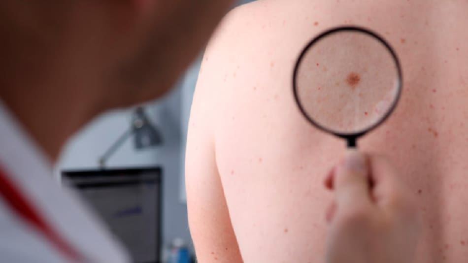 Cáncer de piel. Foto: EFE