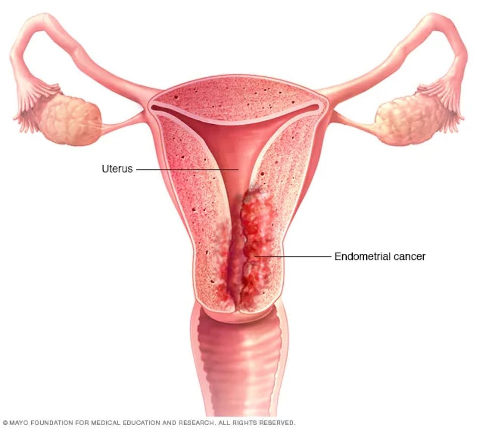 Cáncer de endometrio. Fuente: Mayo Clinic