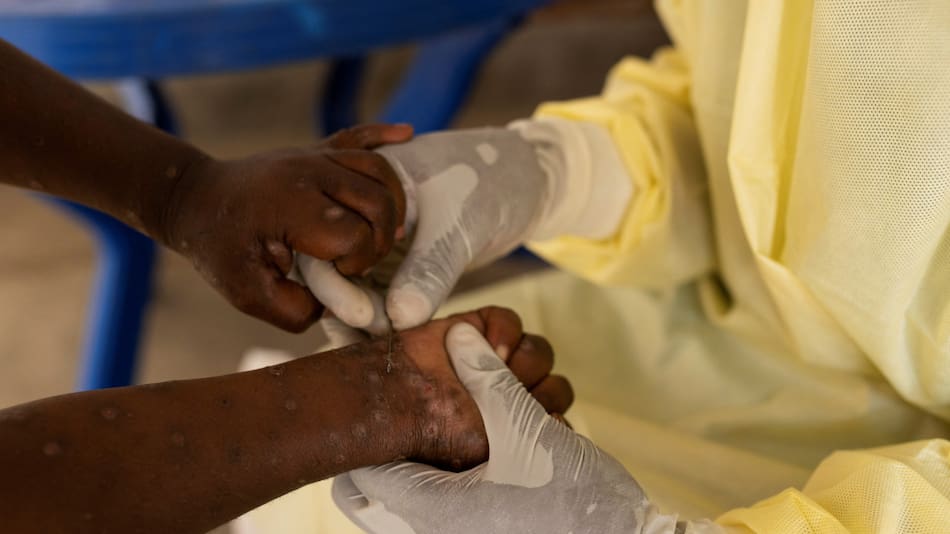 La transmisión del mpox continúa ocurriendo principalmente a través del contacto directo. Foto: Reuters.