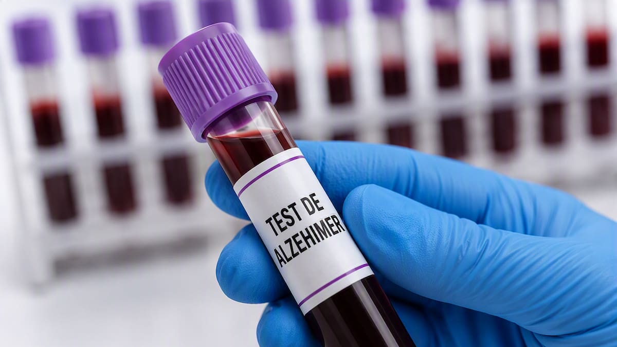 Test de sangre para detectar cambios vinculados al Alzheimer.