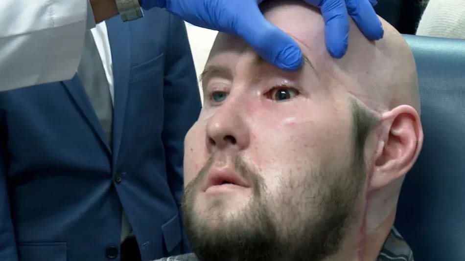 Aaron James, un paciente de 46 años que sobrevivió a una intensa descarga eléctrica por la que perdió su ojo izquierdo. Foto: Twitter
