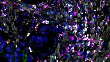 Lucha contra el cáncer: científicos de Argentina descubren tratamiento para frenar el crecimiento de tumores