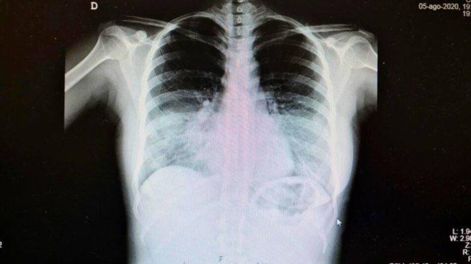 Coronavirus en España, radiografía de pulmones, salud