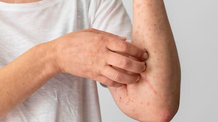 Manchas, picazón y dolor en la piel: cómo reconocer y tratar el sarpullido severo durante los días de calor