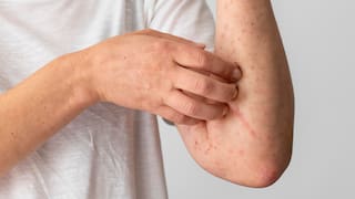 Manchas, picazón y dolor en la piel: cómo reconocer y tratar el sarpullido severo durante los días de calor