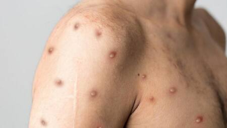 Viruela del mono. Foto: NA.