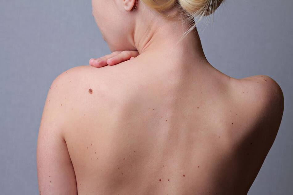 Melanoma - Cáncer de piel