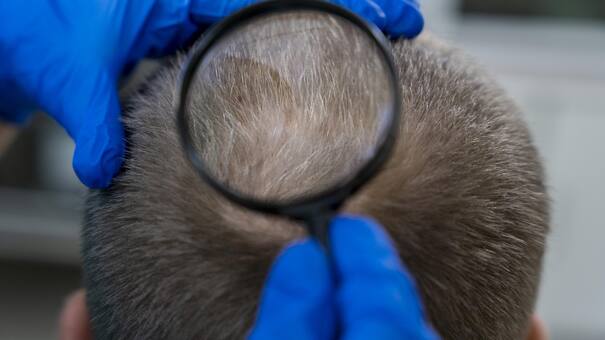 La epidemia silenciosa que aumenta en verano: ¿qué es la tiña capilar y cómo prevenirla?