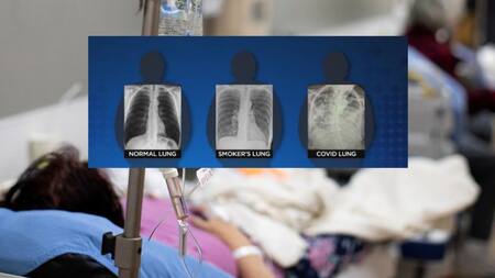 Pulmones y el efecto del coronavirus, foto Reuters y Twitter CBSDFW
