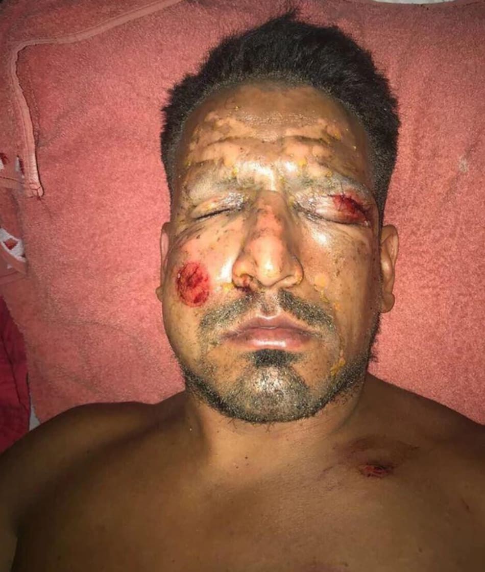 Accidente de Lucas Viatri con pirotecnia