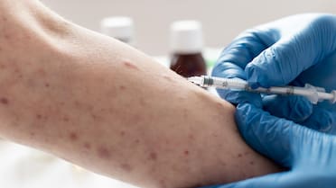 Activan alerta por el crecimiento de casos de sarampión: cuáles son sus síntomas