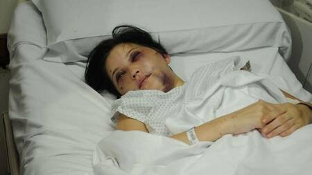 Belén Torres - Golpeada por anestesista