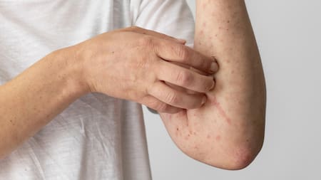 Cuáles son los síntomas del sarampión. Foto Freepik