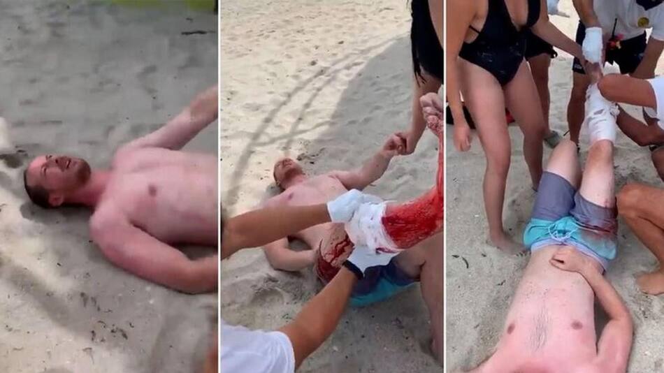 Estados Unidos, nadaba en South Beach cuando fue atacado por un tiburón que le hizo una grave herida