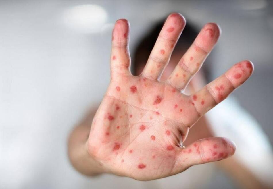 Viruela del mono. Foto: NA.