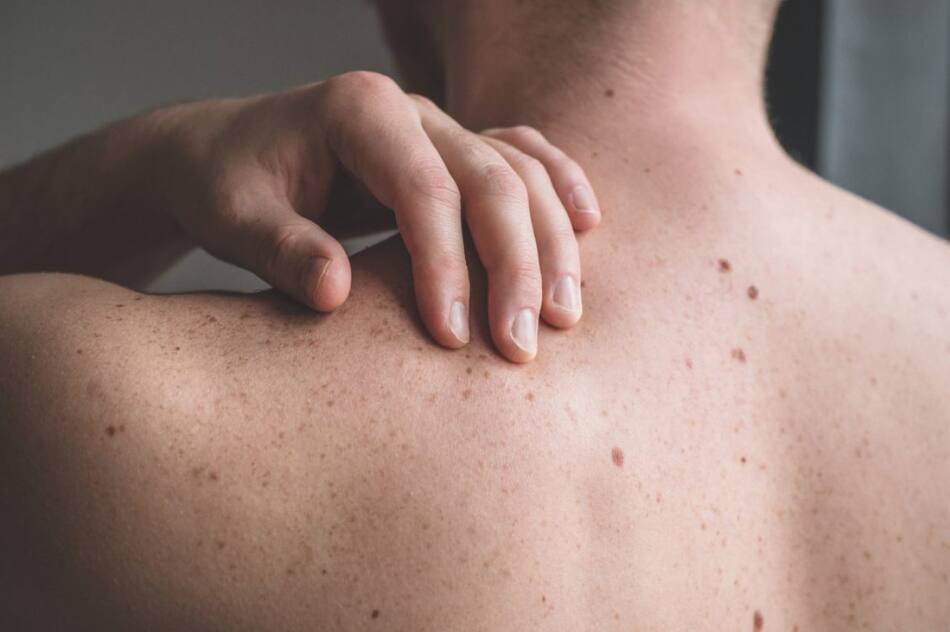 Cáncer de piel. Foto: EFE