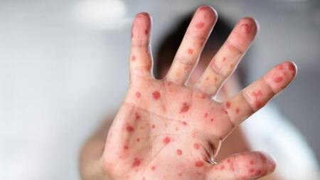 Viruela del mono. Foto: NA.