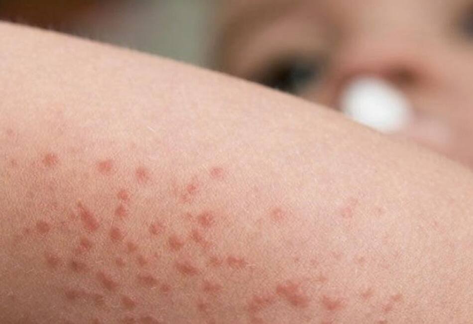 Dermatitis atópica