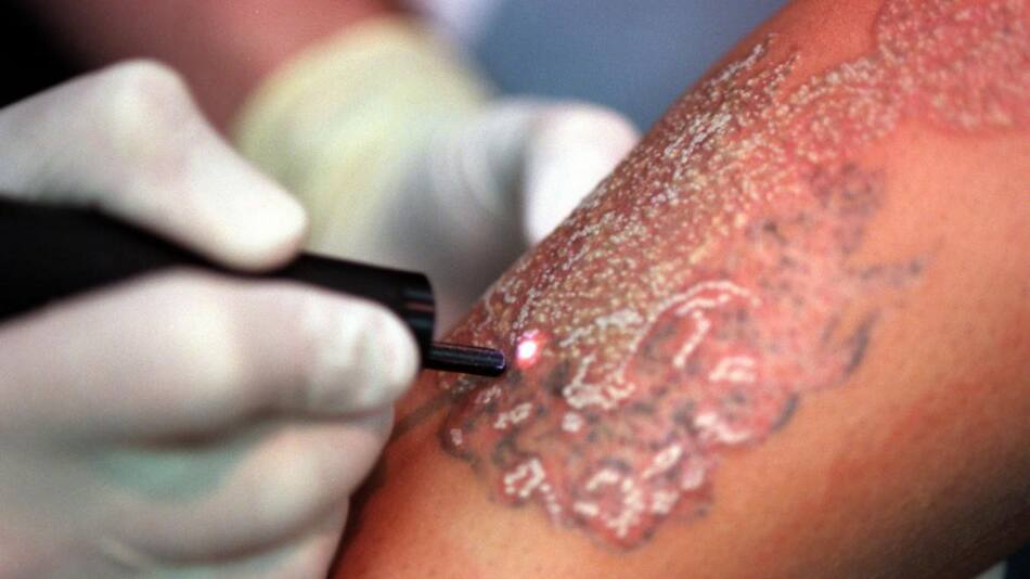 Se quiso borrar el tatuaje con nombre de su exesposa y todo resulta un desastre