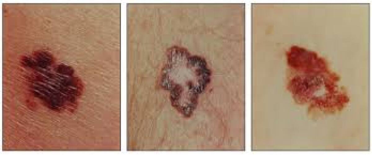 Tipos de melanoma. Foto: National Cancer Institute