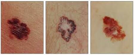 Tipos de melanoma. Foto: National Cancer Institute