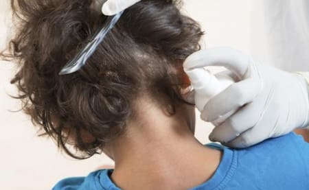 Pediculosis. Foto: X