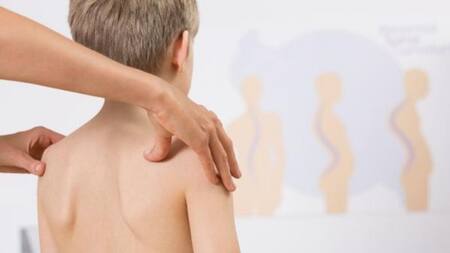 Escoliosis - Salud