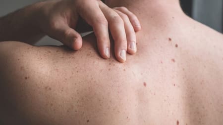 Cáncer de piel. Foto: EFE