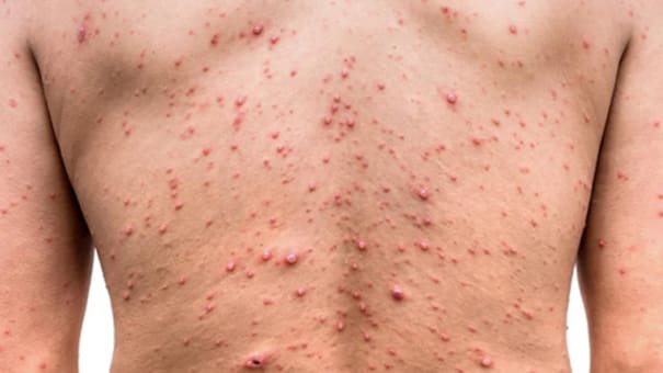 Detectan 11 nuevos casos de viruela del mono en CABA y provincia de Buenos Aires