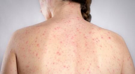 Investigan los contactos directos de la joven embarazada contagiada de sarampión en el exterior