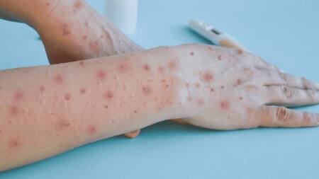 Viruela del mono. Foto: NA.