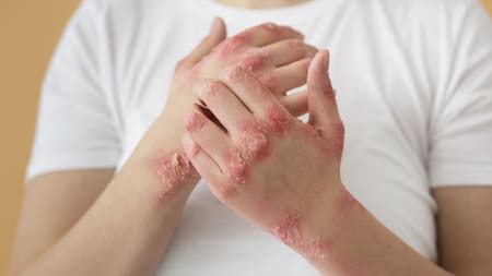 Preocupante aumento de sífilis en adolescentes y bebés en Argentina: métodos de prevención y tratamientos