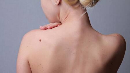 Melanoma - Cáncer de piel