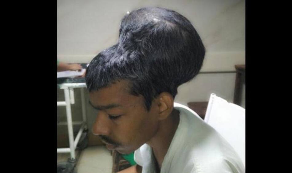 Tumor - India