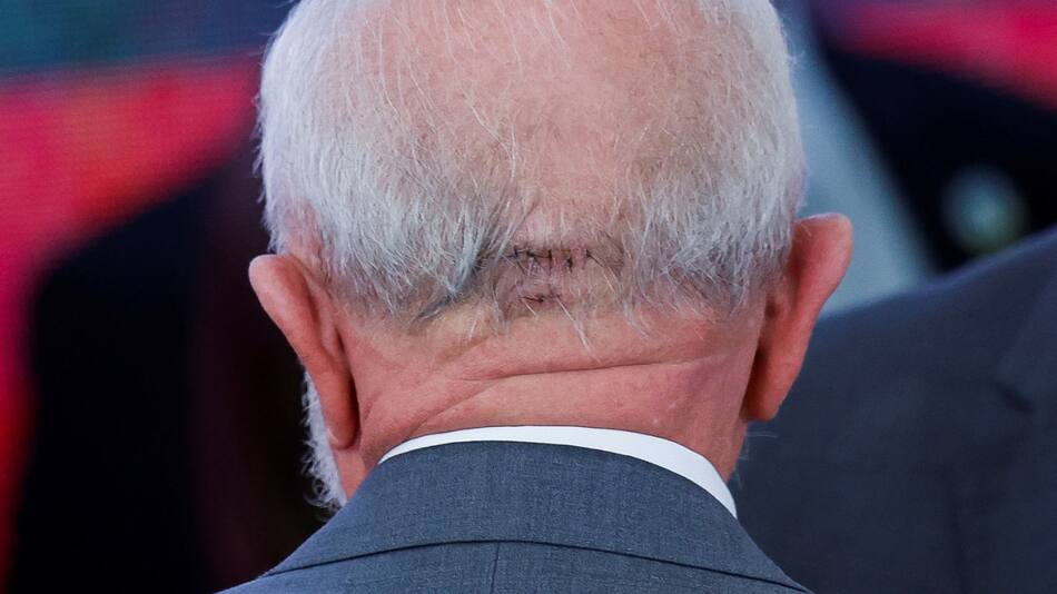 Qué es una hemorragia intracraneal. Foto: Reuters