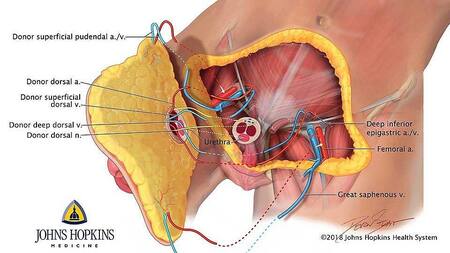 Trasplante completo de pene y escroto, Johns Hopkins